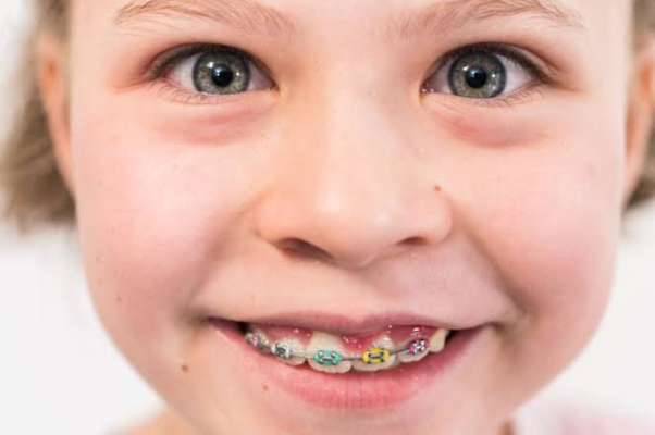 What Parents Should Know About Extra Teeth In Children